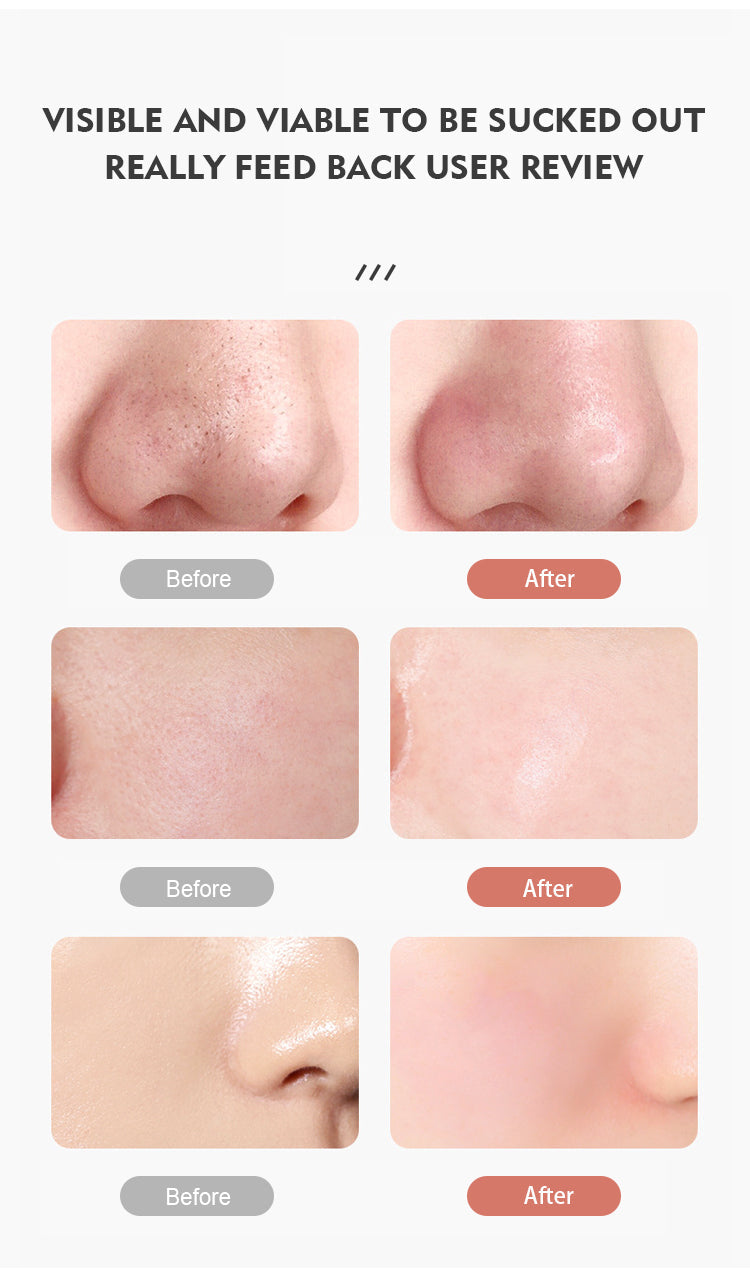 Electric Vacuum Blackhead Remover