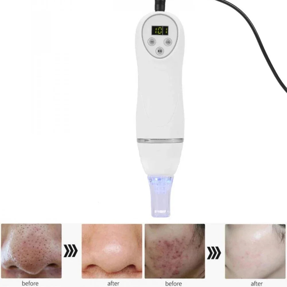 Digital Microdermabrasion Diamond Dermabrasion Pen Vacuum Massage Skin Peeling Acne Treatment Blackhead Cleanse Beauty Equipment – Deep Cleansing Pro