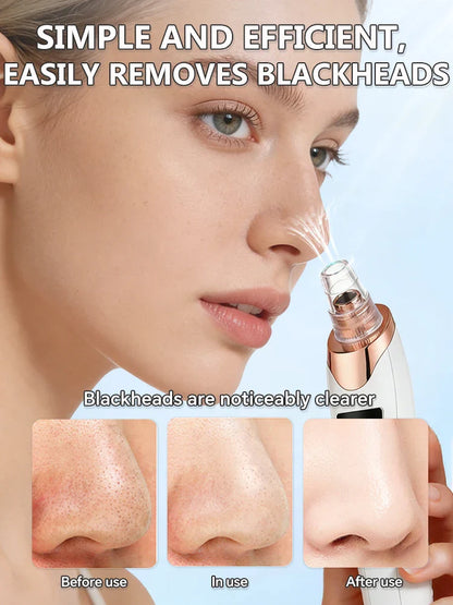 Blackhead Remover Vacuum