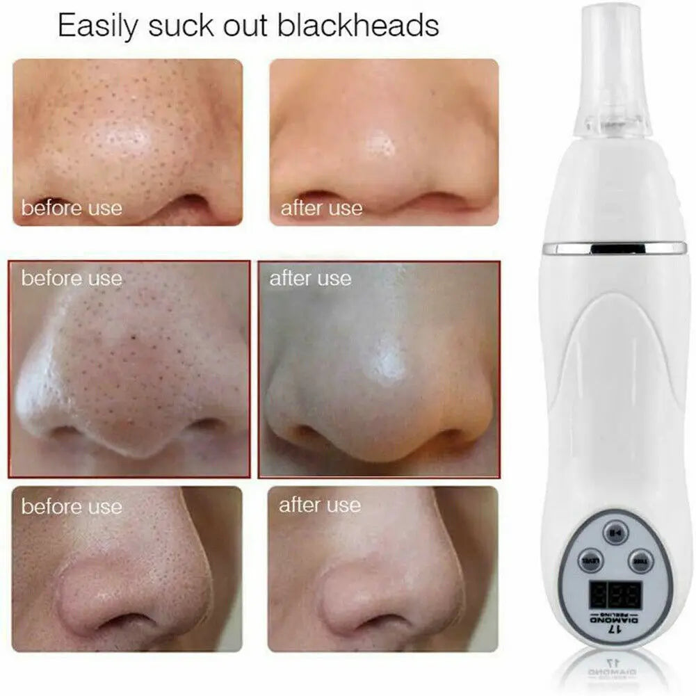 Digital Microdermabrasion Diamond Dermabrasion Pen Vacuum Massage Skin Peeling Acne Treatment Blackhead Cleanse Beauty Equipment – Deep Cleansing Pro